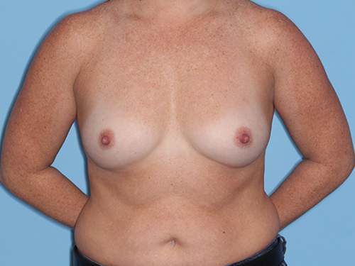 Case--37766 | Before Breast Augmentation 1