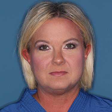 Case--39150 | Before Eyelid Surgery (Blepharoplasty) 1