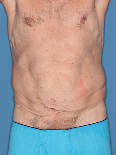 Case--40026 | Before True Form Tummy Tuck® for Men 1