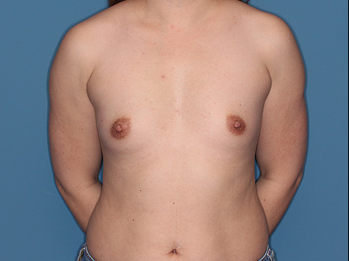 Case--40368 | Before Breast Augmentation 1