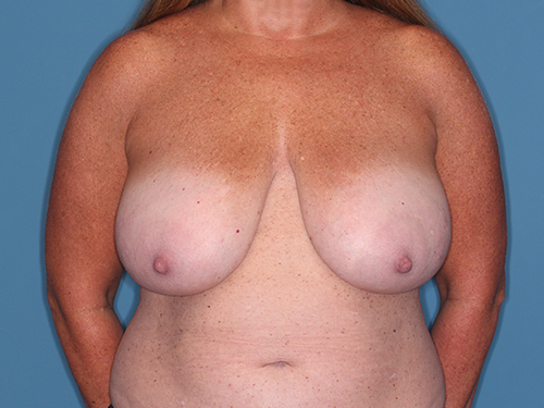 Case--45021 | Before Breast Lift 1