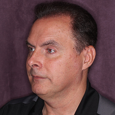 Case--36831 | Before Facelift and Neck Lift for Men 3
