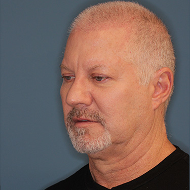 Case--40290 | Before Facelift and Neck Lift for Men 3