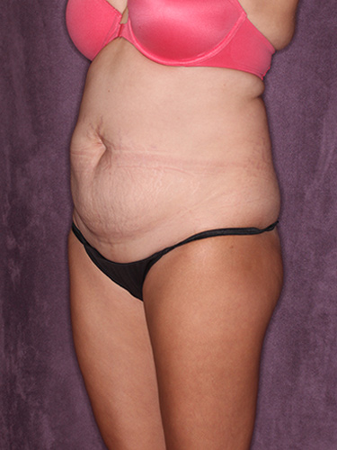 Case--37353 | Before Fat Transfer to Buttocks 3
