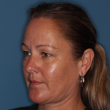 Case--40014 | Before Eyelid Surgery (Blepharoplasty) 3