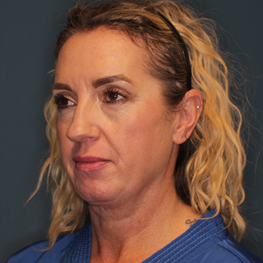 Case--43126 | Before Eyelid Surgery (Blepharoplasty) 3