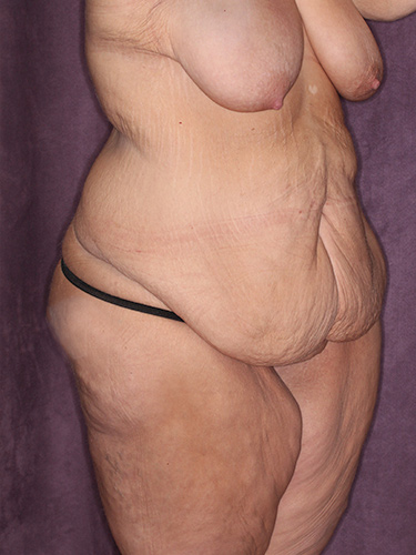 Case--39643 | Before Thigh Lift 2