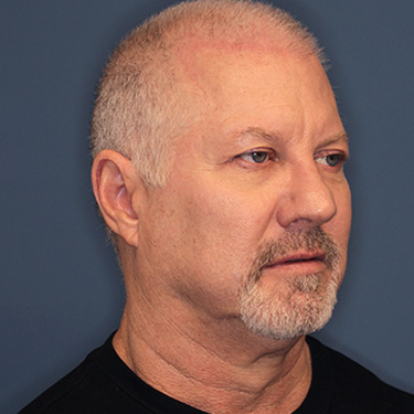 Case--40290 | Before Facelift and Neck Lift for Men 2