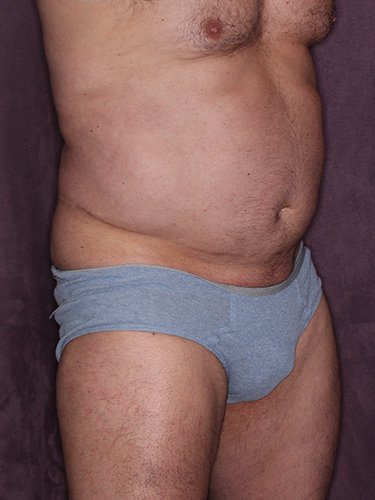 Case--36808 | Before True Form Tummy Tuck® for Men 2