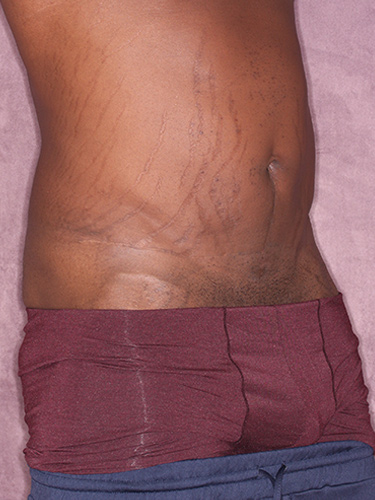 Case--36791 | Before True Form Tummy Tuck® for Men 2