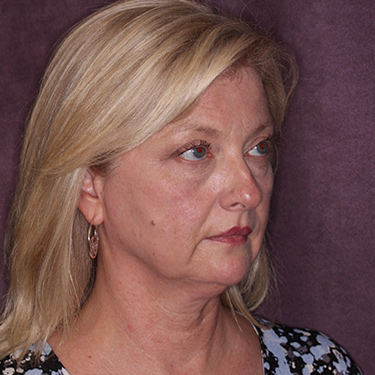 Case--36776 | Before Eyelid Surgery (Blepharoplasty) 2