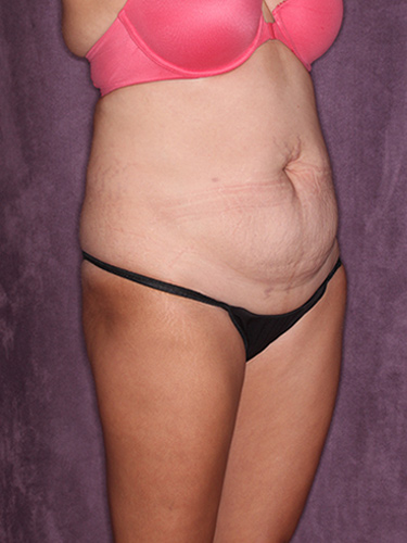 Case--37353 | Before Fat Transfer to Buttocks 2