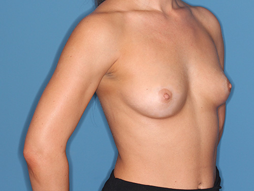 Case--39255 | Before Breast Augmentation 2