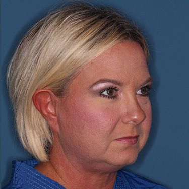 Case--39150 | Before Eyelid Surgery (Blepharoplasty) 2