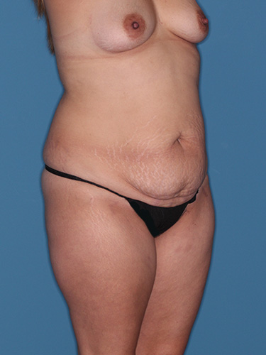 Case--41922 | Before Fat Transfer to Buttocks 2