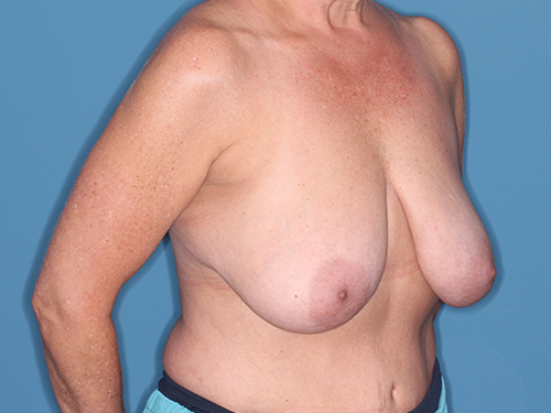 Case--40467 | Before Breast Lift with Breast Reduction 2