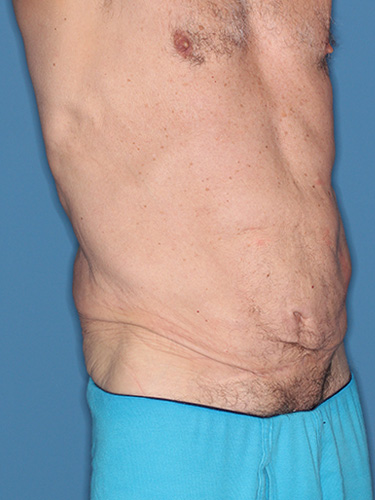 Case--40026 | Before True Form Tummy Tuck® for Men 2