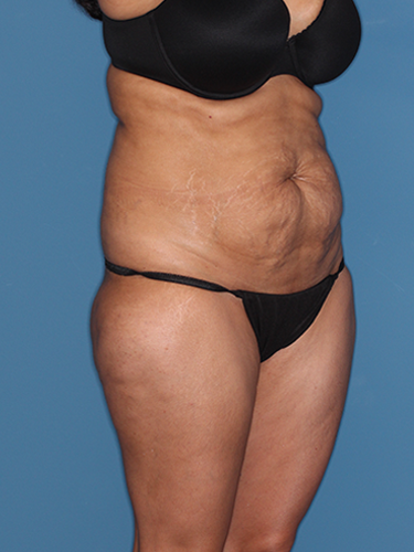 Case--43533 | Before True Form Tummy Tuck® 2