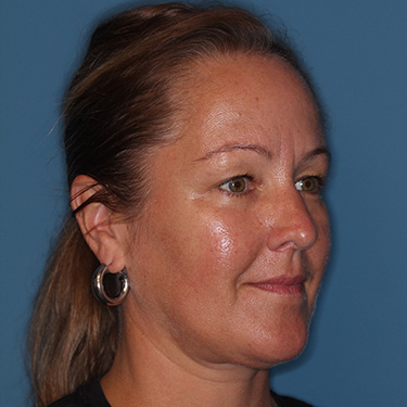 Case--40014 | Before Eyelid Surgery (Blepharoplasty) 2