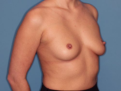 Case--40437 | Before Breast Augmentation 2