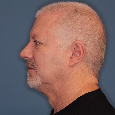 Case--40290 | Before Facelift and Neck Lift for Men 5