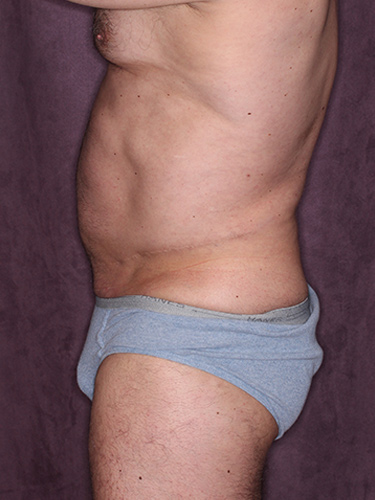 Case--36808 | Before True Form Tummy Tuck® for Men 5