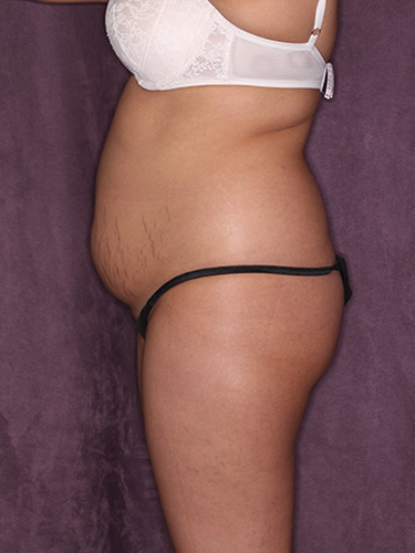 Case--37319 | Before Fat Transfer to Buttocks 5