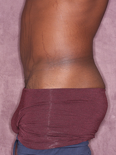 Case--36791 | Before True Form Tummy Tuck® for Men 5