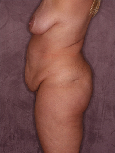 Case--37163 | Before True Form Tummy Tuck® with Lower Body Lift (Buttock Lift) 5
