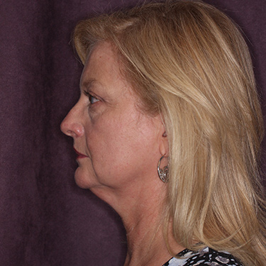 Case--36776 | Before Eyelid Surgery (Blepharoplasty) 5