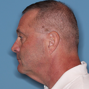 Case--41459 | Before Facelift and Neck Lift for Men 5