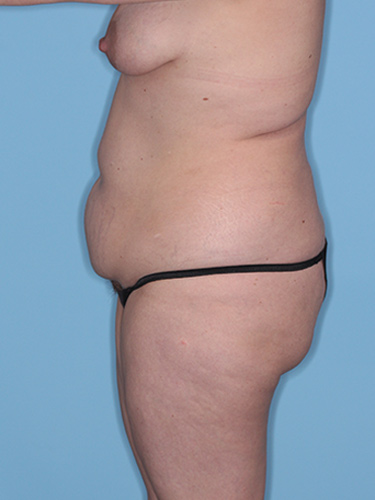 Case--37797 | Before True Form Tummy Tuck® with Lower Body Lift (Buttock Lift) 5
