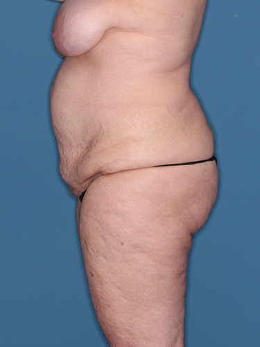 Case--40335 | Before True Form Tummy Tuck® in Overweight & Weight Loss Patients 5