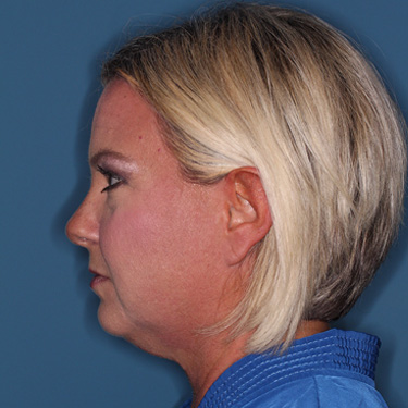 Case--39150 | Before Eyelid Surgery (Blepharoplasty) 5