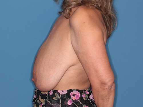 Case--40187 | Before Breast Lift 5