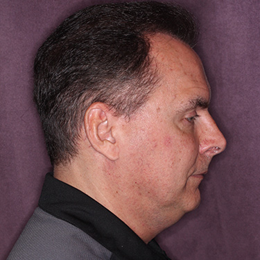 Case--36831 | Before Facelift and Neck Lift for Men 4