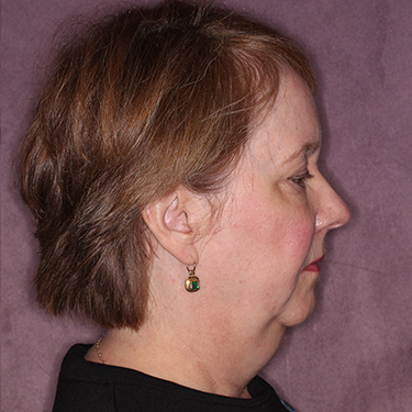 Case--36018 | Before Fat Grafting 3