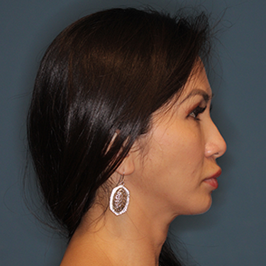 Case--45087 | Before Mini Facelift 4