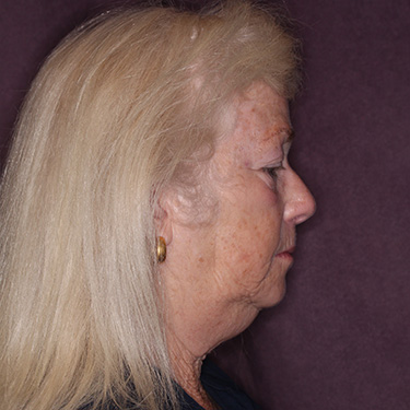 Case--39696 | Before Eyelid Surgery (Blepharoplasty) 4