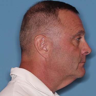 Case--41459 | Before Facelift and Neck Lift for Men 4