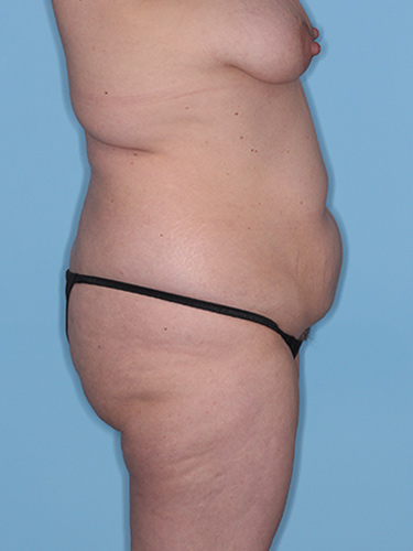 Case--37797 | Before True Form Tummy Tuck® with Lower Body Lift (Buttock Lift) 4