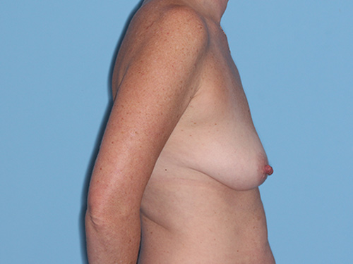 Case--38136 | Before Fat Grafting to Breasts 4
