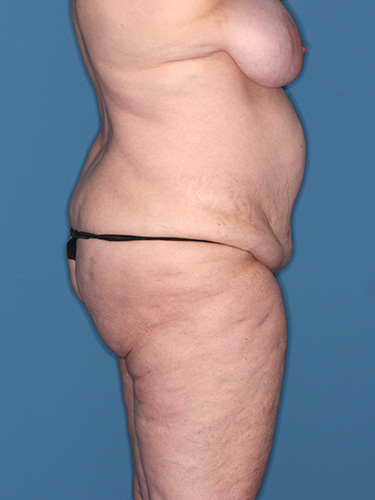 Case--40335 | Before True Form Tummy Tuck® in Overweight & Weight Loss Patients 4