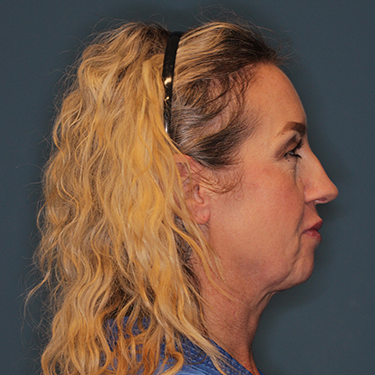 Case--43126 | Before Eyelid Surgery (Blepharoplasty) 4