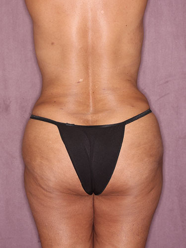 Case--32318 | After True Form Tummy Tuck® in Overweight & Weight Loss Patients 6