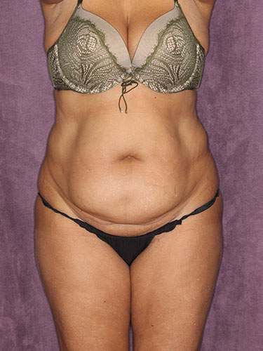 Case--32318 | Before True Form Tummy Tuck® in Overweight & Weight Loss Patients 1