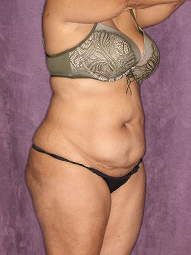 Case--32318 | Before True Form Tummy Tuck® in Overweight & Weight Loss Patients 2
