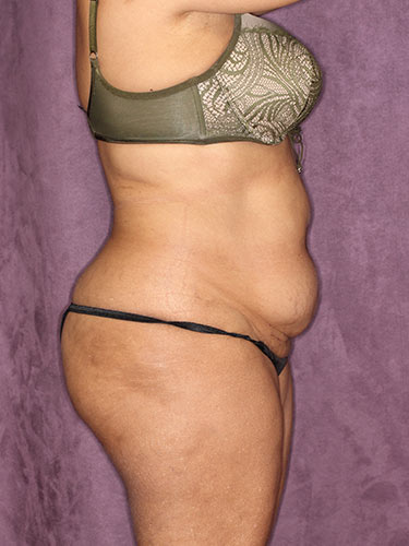 Case--32318 | Before True Form Tummy Tuck® in Overweight & Weight Loss Patients 3