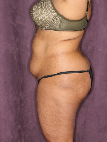Case--32318 | Before True Form Tummy Tuck® in Overweight & Weight Loss Patients 5