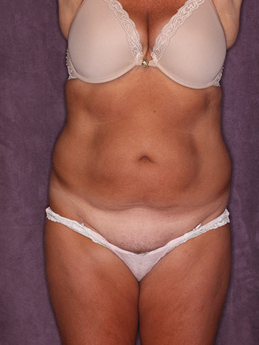 Case--32379 | Before Fat Transfer to Buttocks 1